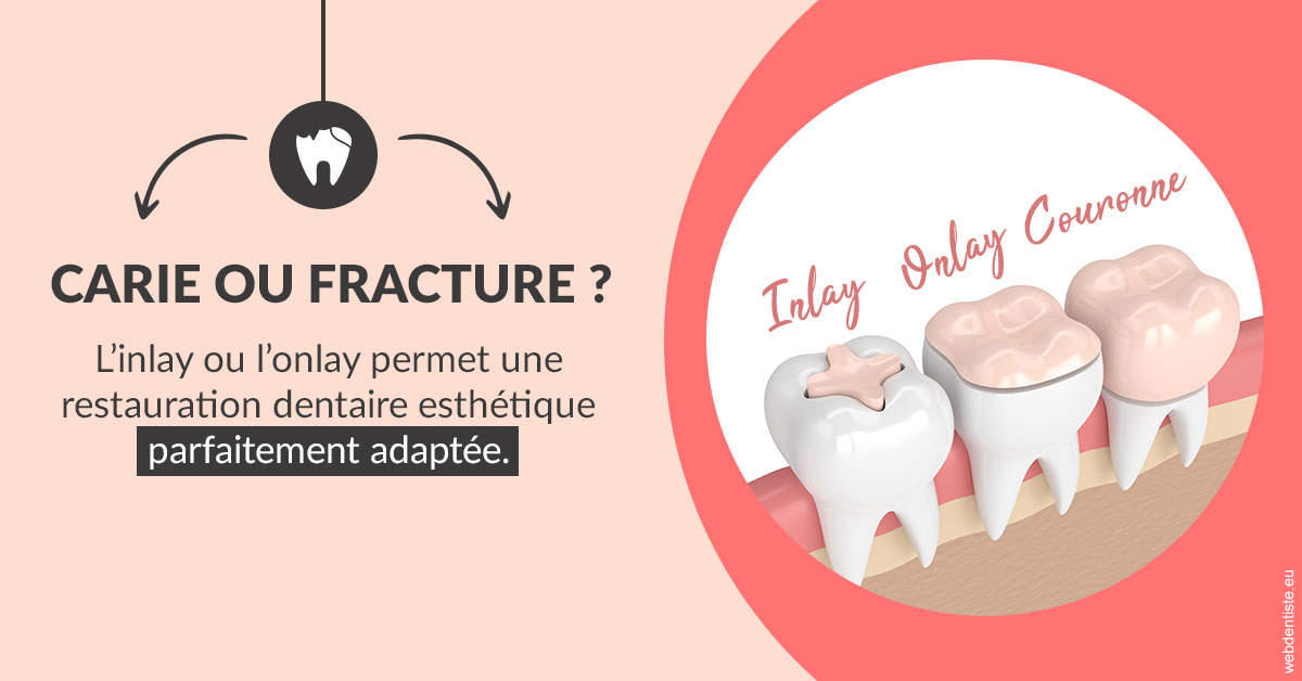 https://dr-domngang-olivier.chirurgiens-dentistes.fr/T2 2023 - Carie ou fracture 2