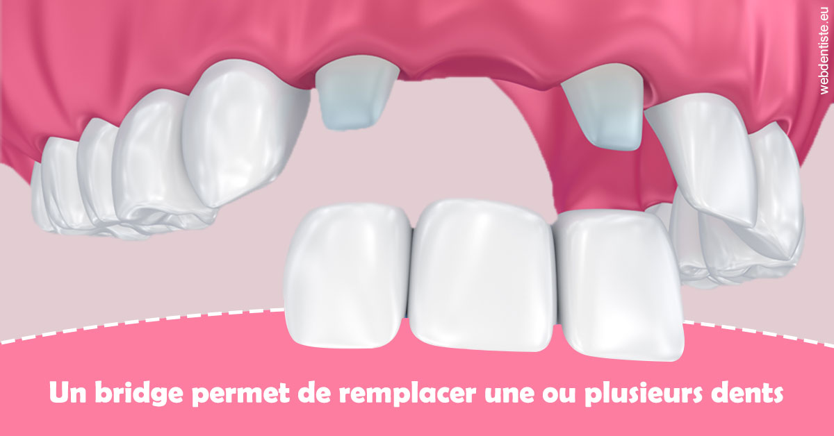https://dr-domngang-olivier.chirurgiens-dentistes.fr/Bridge remplacer dents 2