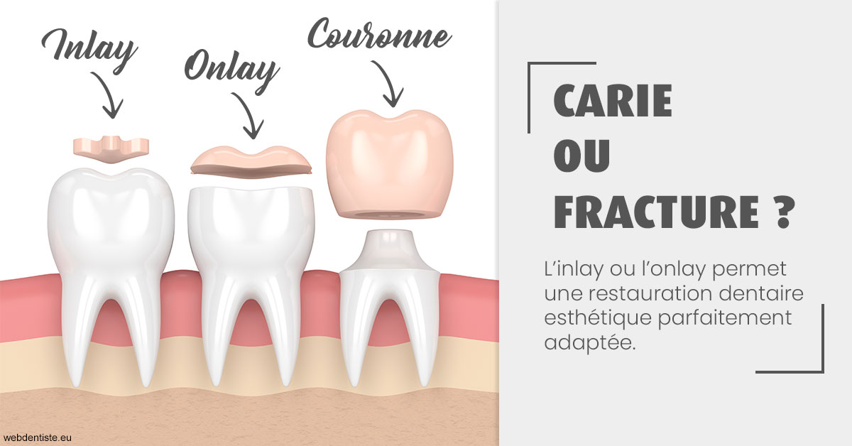 https://dr-domngang-olivier.chirurgiens-dentistes.fr/T2 2023 - Carie ou fracture 1