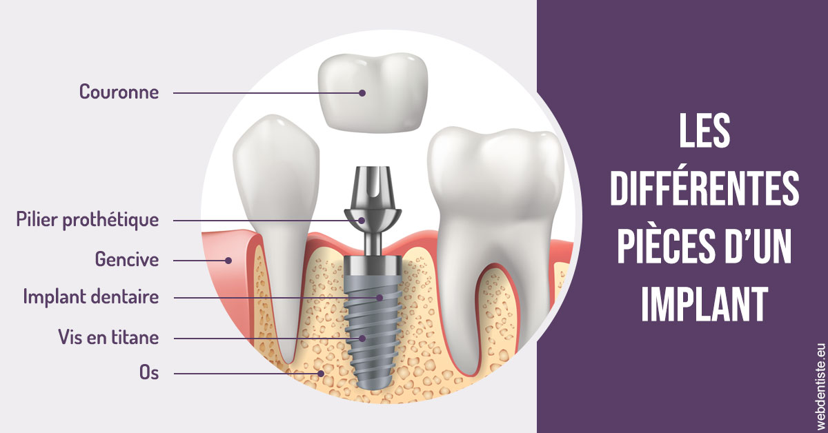 https://dr-domngang-olivier.chirurgiens-dentistes.fr/Les différentes pièces d’un implant 2