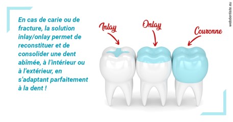 https://dr-domngang-olivier.chirurgiens-dentistes.fr/L'INLAY ou l'ONLAY