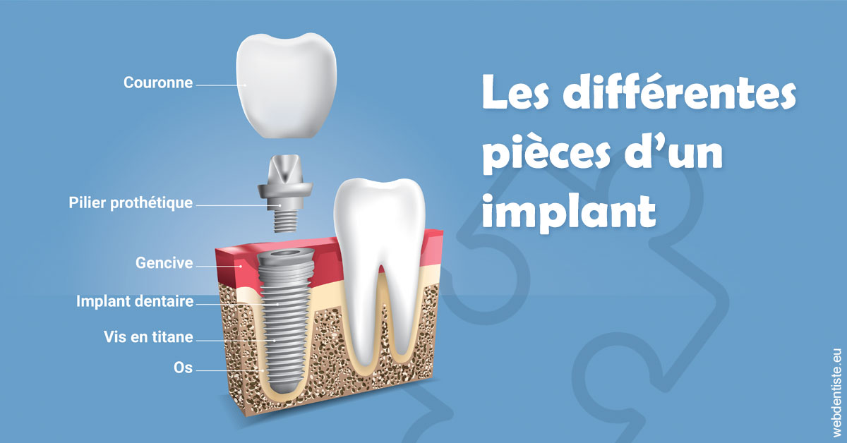 https://dr-domngang-olivier.chirurgiens-dentistes.fr/Les différentes pièces d’un implant 1